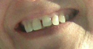 bad teeth for Gina testimonial