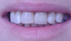 good teeth for Gina testimonial