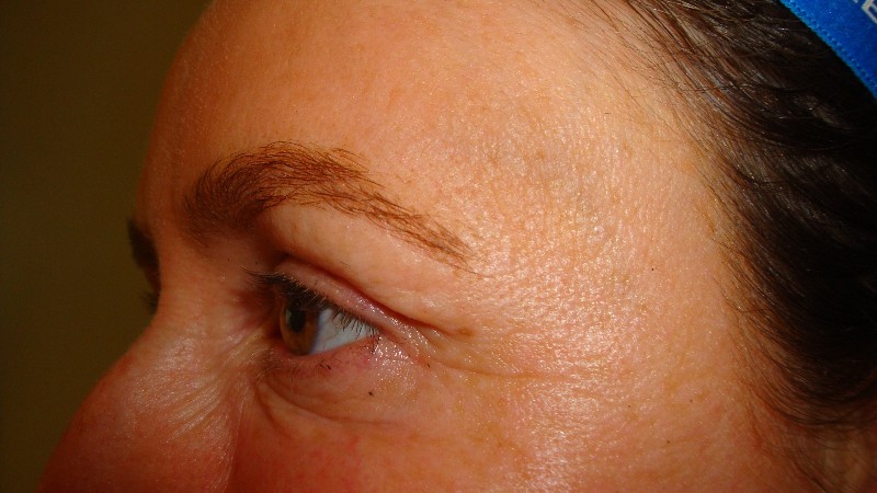 After-Crows Feet Treatment 1
