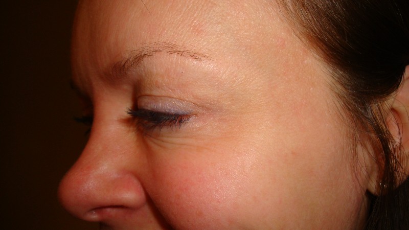 After-Crows Feet Treatment 2