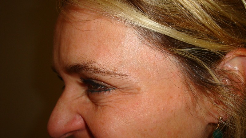 After-Crows Feet Treatment 4