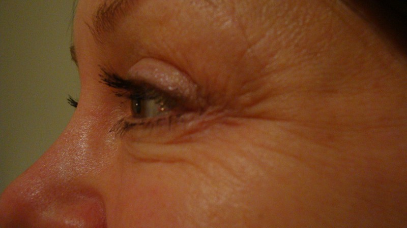 Before-Crows Feet Treatment 2