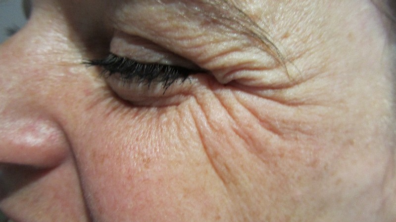 Before-Crows Feet Treatment 4