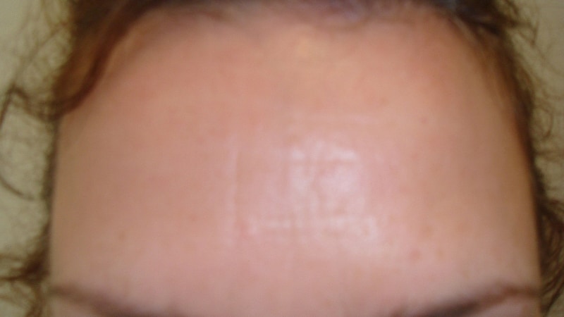 After-Forehead Line Elimination 1