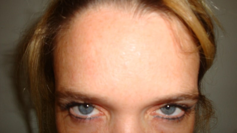 After-Forehead Line Elimination 3