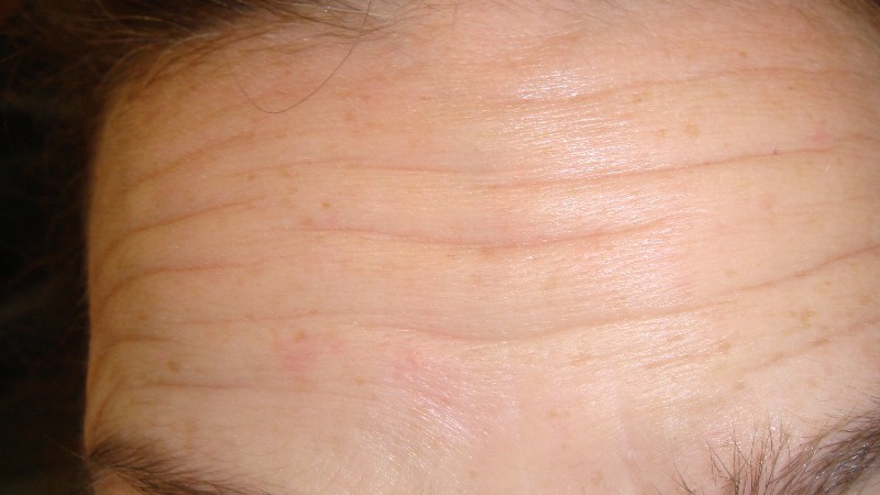 Before-Forehead Line Elimination 1