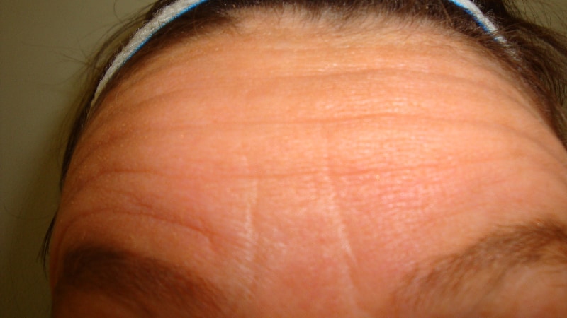 Before-Forehead Line Elimination 2
