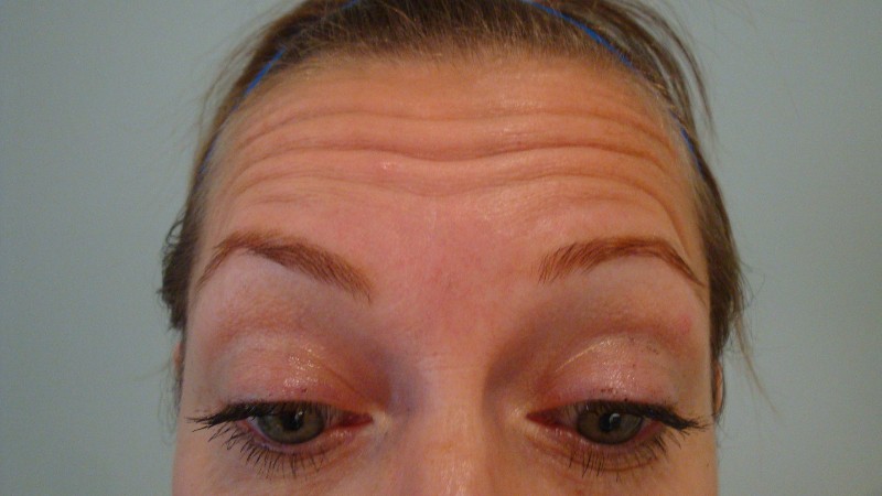 Before-Forehead Line Elimination 4