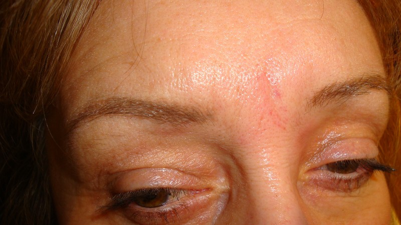 After-Frown Line Treatment 1