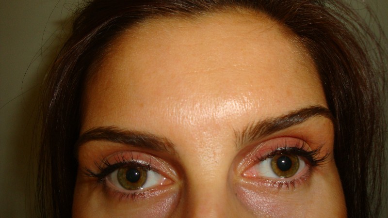 After-Frown Line Treatment 2