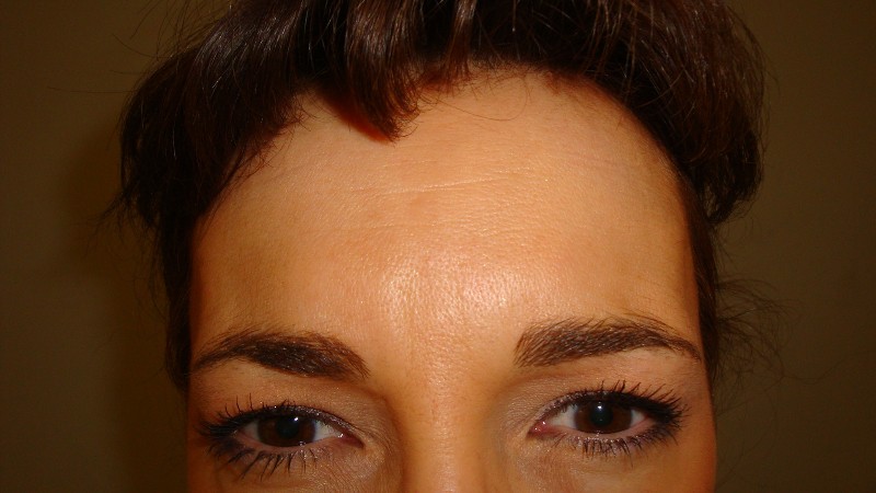 After-Frown Line Treatment 3