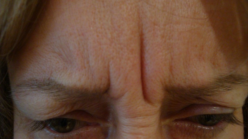 Before-Frown Line Treatment 1