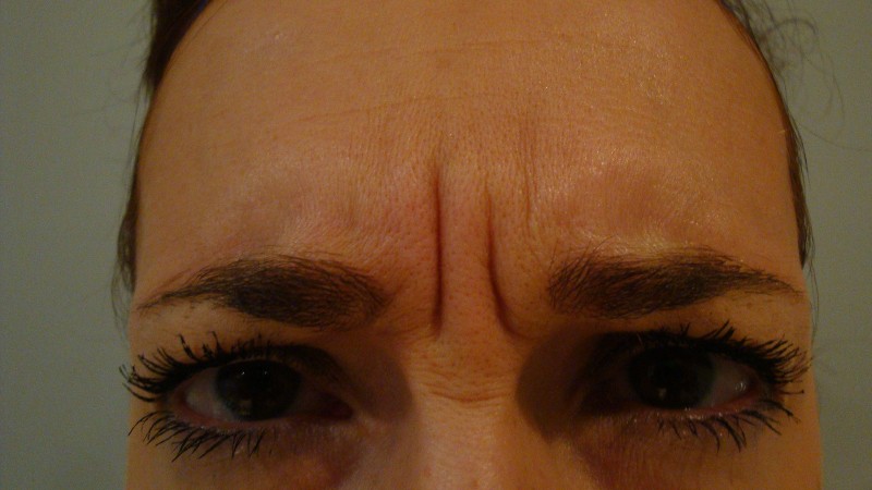 Before-Frown Line Treatment 3